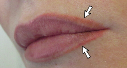 Lips Removal
