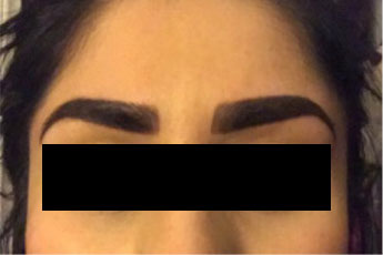 micro blading removal and help